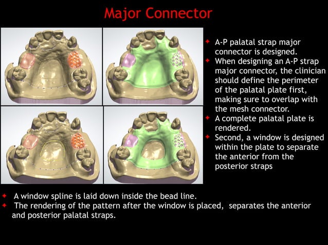 Digital design of maxillary of rpd's | PDF