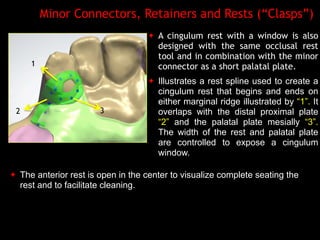 Digital design of maxillary of rpd's | PDF