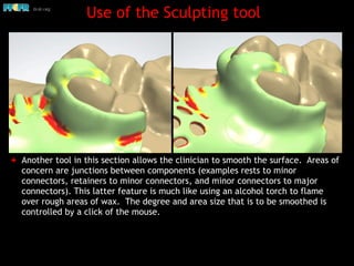 Maxillary Rp Digital design of maxillary of rpd's | PDF