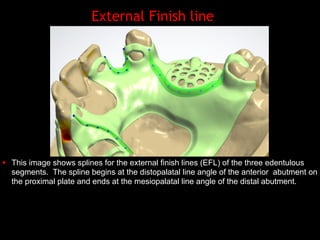 External Finish Line Rpd Digital design of maxillary of rpd's | PDF