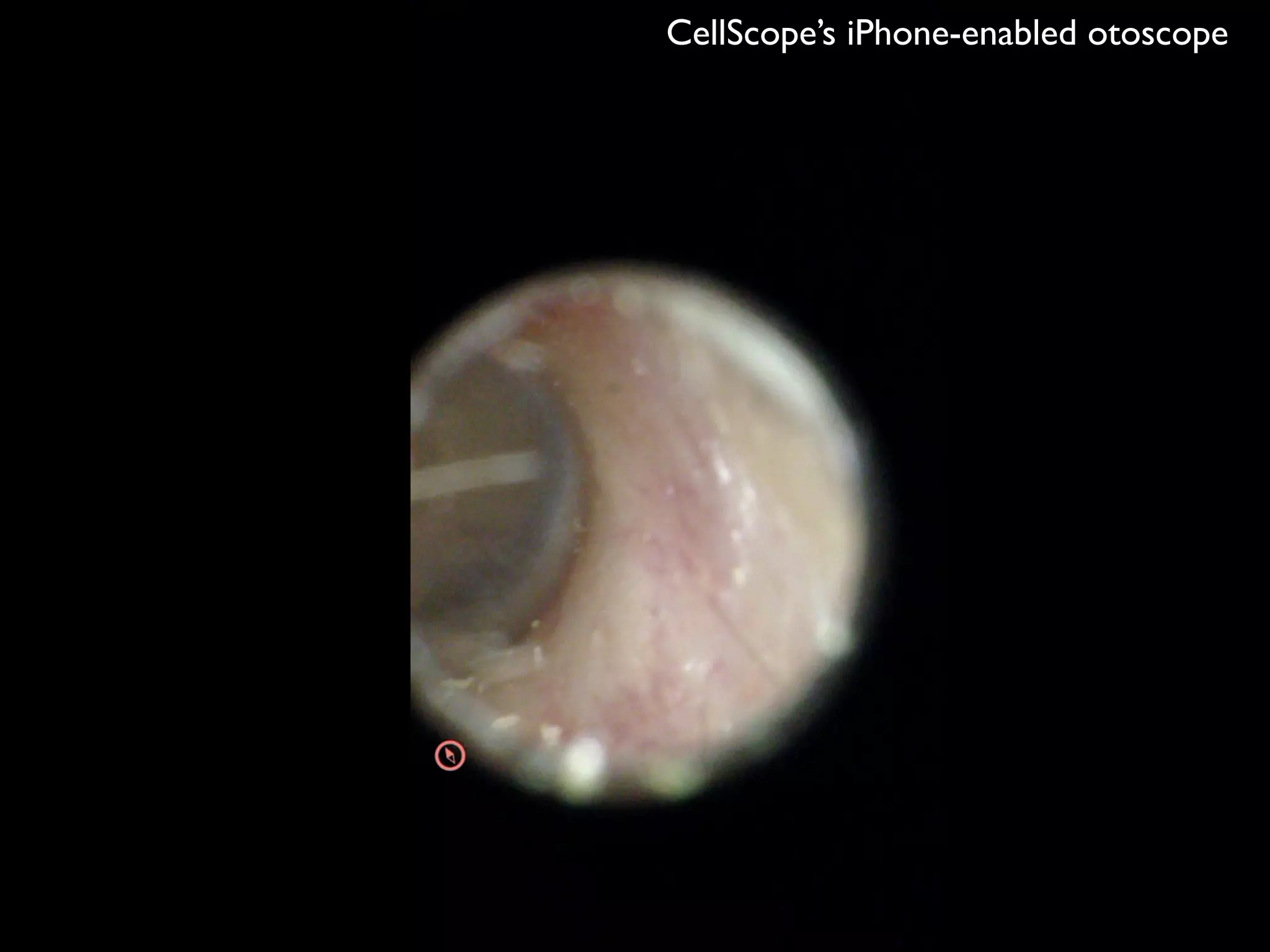 CellScope’s iPhone-enabled otoscope
 