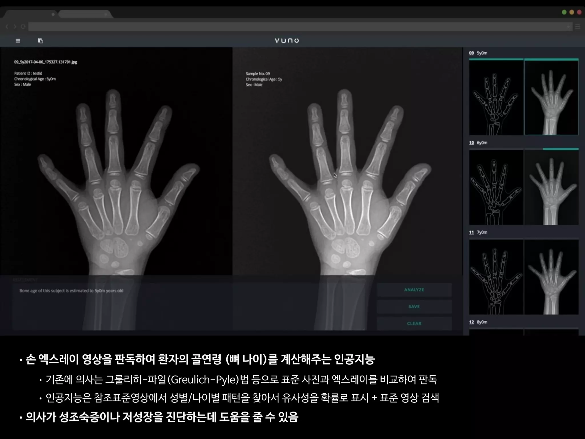 •손 엑스레이 영상을 판독하여 환자의 골연령 (뼈 나이)를 계산해주는 인공지능

• 기존에 의사는 그룰리히-파일(Greulich-Pyle)법 등으로 표준 사진과 엑스레이를 비교하여 판독

• 인공지능은 참조표준영상에서 성별/나이별 패턴을 찾아서 유사성을 확률로 표시 + 표준 영상 검색

•의사가 성조숙증이나 저성장을 진단하는데 도움을 줄 수 있음
 