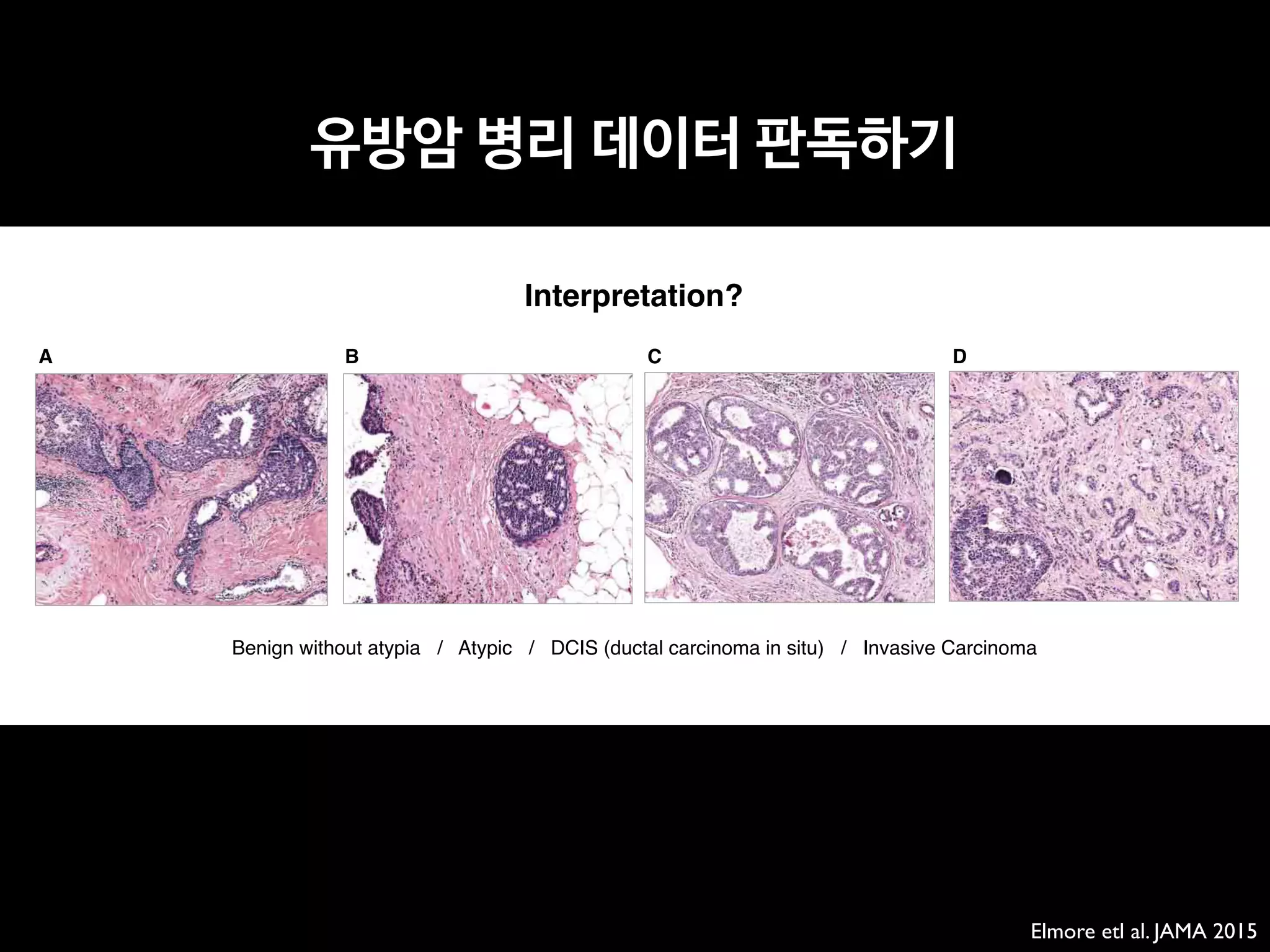 A B DC
Benign without atypia / Atypic / DCIS (ductal carcinoma in situ) / Invasive Carcinoma
Interpretation?
Elmore etl al. JAMA 2015
Diagnostic Concordance Among Pathologists 

유방암 병리 데이터 판독하기
 