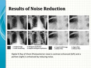 Results of Noise Reduction
Digital X-Ray of Chest (Postoanterior view) is contrast enhanced (left) and a
portion (right) is enhanced by reducing noise.
 