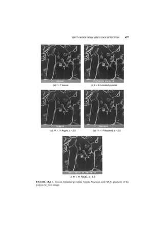 FIRST-ORDER DERIVATIVE EDGE DETECTION               457




               (a) 7 × 7 boxcar                       (b) 9 × 9 truncated pyramid




             (c) 11 × 11 Argyle, s = 2.0                (d ) 11 × 11 Macleod, s = 2.0




                                  (e) 11 × 11 FDOG, s = 2.0

FIGURE 15.2-7. Boxcar, truncated pyramid, Argyle, Macleod, and FDOG gradients of the
peppers_mon image.
 