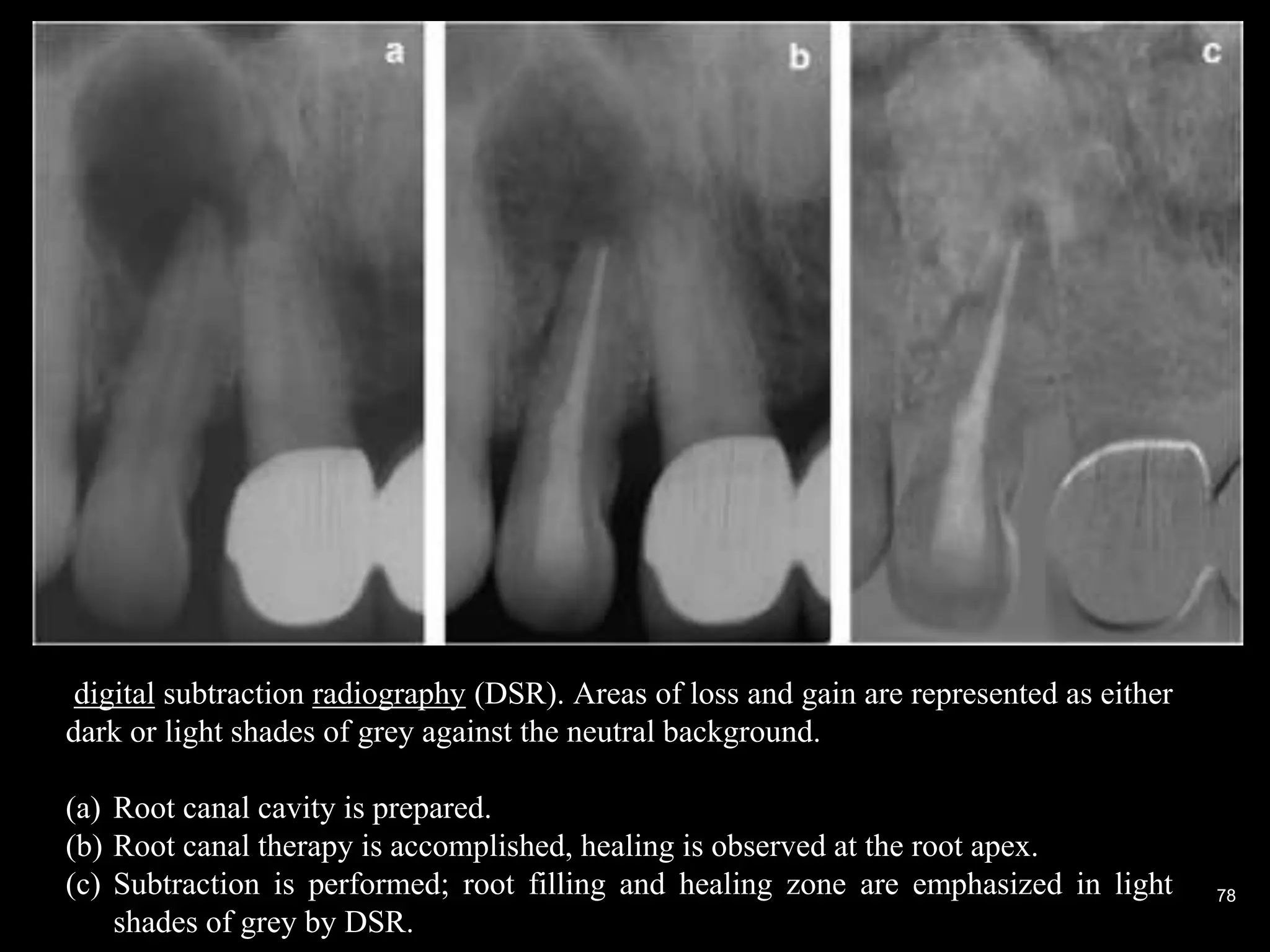 78
digital subtraction radiography (DSR). Areas of loss and gain are represented as either
dark or light shades of grey against the neutral background.
(a) Root canal cavity is prepared.
(b) Root canal therapy is accomplished, healing is observed at the root apex.
(c) Subtraction is performed; root filling and healing zone are emphasized in light
shades of grey by DSR.
 