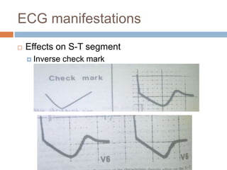 ECG manifestations
 Effects on S-T segment
 Inverse check mark
 