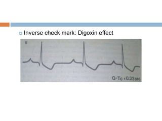  Inverse check mark: Digoxin effect
 