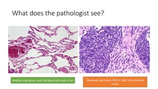 What does the pathologist see?
Healthy lung tissue; note the blood and sacks of air Diseased lung tissue; NSCLC; tight cells; bloated
nuclei
 