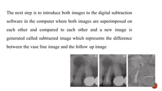 The next step is to introduce both images to the digital subtraction
software in the computer where both images are superimposed on
each other and compared to each other and a new image is
generated called subtracted image which represents the difference
between the vase line image and the follow up image
 