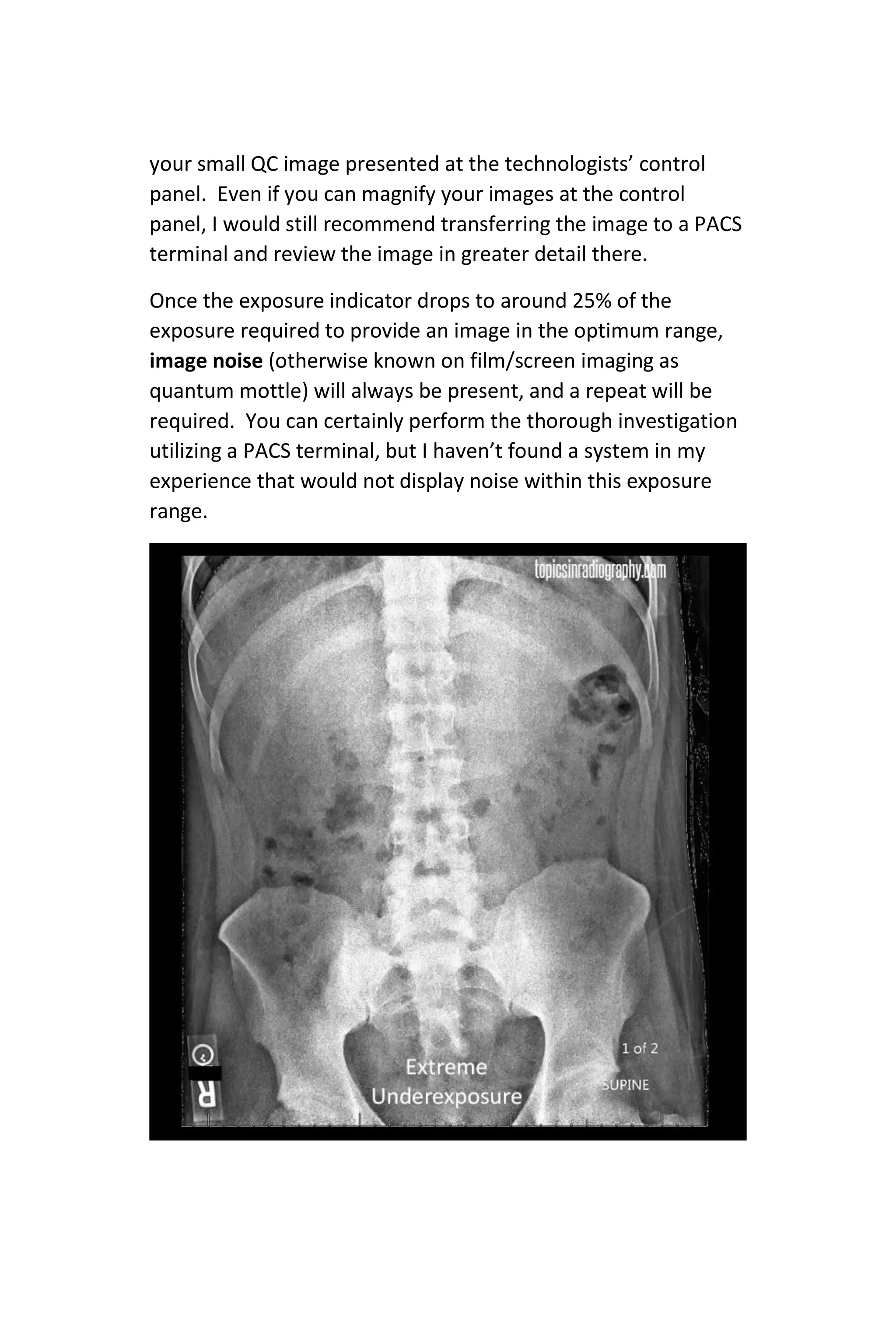 your small QC image presented at the technologists’ control
panel. Even if you can magnify your images at the control
panel, I would still recommend transferring the image to a PACS
terminal and review the image in greater detail there.
Once the exposure indicator drops to around 25% of the
exposure required to provide an image in the optimum range,
image noise (otherwise known on film/screen imaging as
quantum mottle) will always be present, and a repeat will be
required. You can certainly perform the thorough investigation
utilizing a PACS terminal, but I haven’t found a system in my
experience that would not display noise within this exposure
range.
 