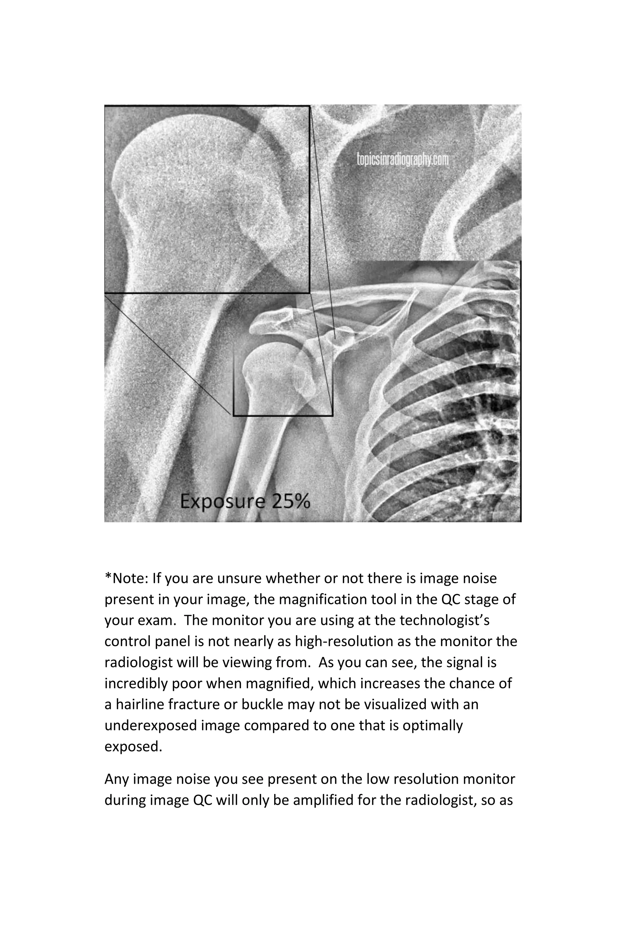 *Note: If you are unsure whether or not there is image noise
present in your image, the magnification tool in the QC stage of
your exam. The monitor you are using at the technologist’s
control panel is not nearly as high-resolution as the monitor the
radiologist will be viewing from. As you can see, the signal is
incredibly poor when magnified, which increases the chance of
a hairline fracture or buckle may not be visualized with an
underexposed image compared to one that is optimally
exposed.
Any image noise you see present on the low resolution monitor
during image QC will only be amplified for the radiologist, so as
 