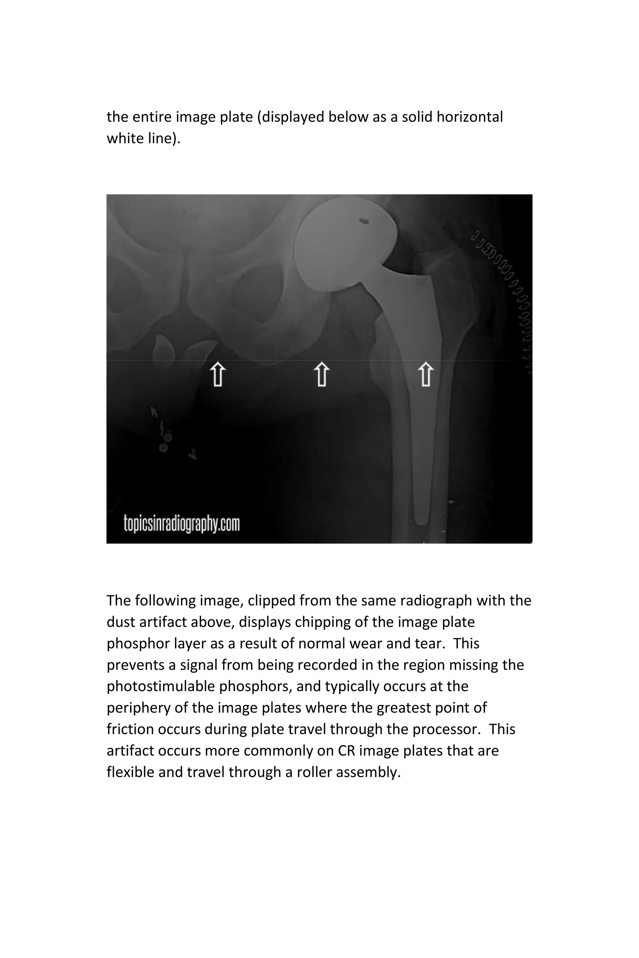 the entire image plate (displayed below as a solid horizontal
white line).
The following image, clipped from the same radiograph with the
dust artifact above, displays chipping of the image plate
phosphor layer as a result of normal wear and tear. This
prevents a signal from being recorded in the region missing the
photostimulable phosphors, and typically occurs at the
periphery of the image plates where the greatest point of
friction occurs during plate travel through the processor. This
artifact occurs more commonly on CR image plates that are
flexible and travel through a roller assembly.
 