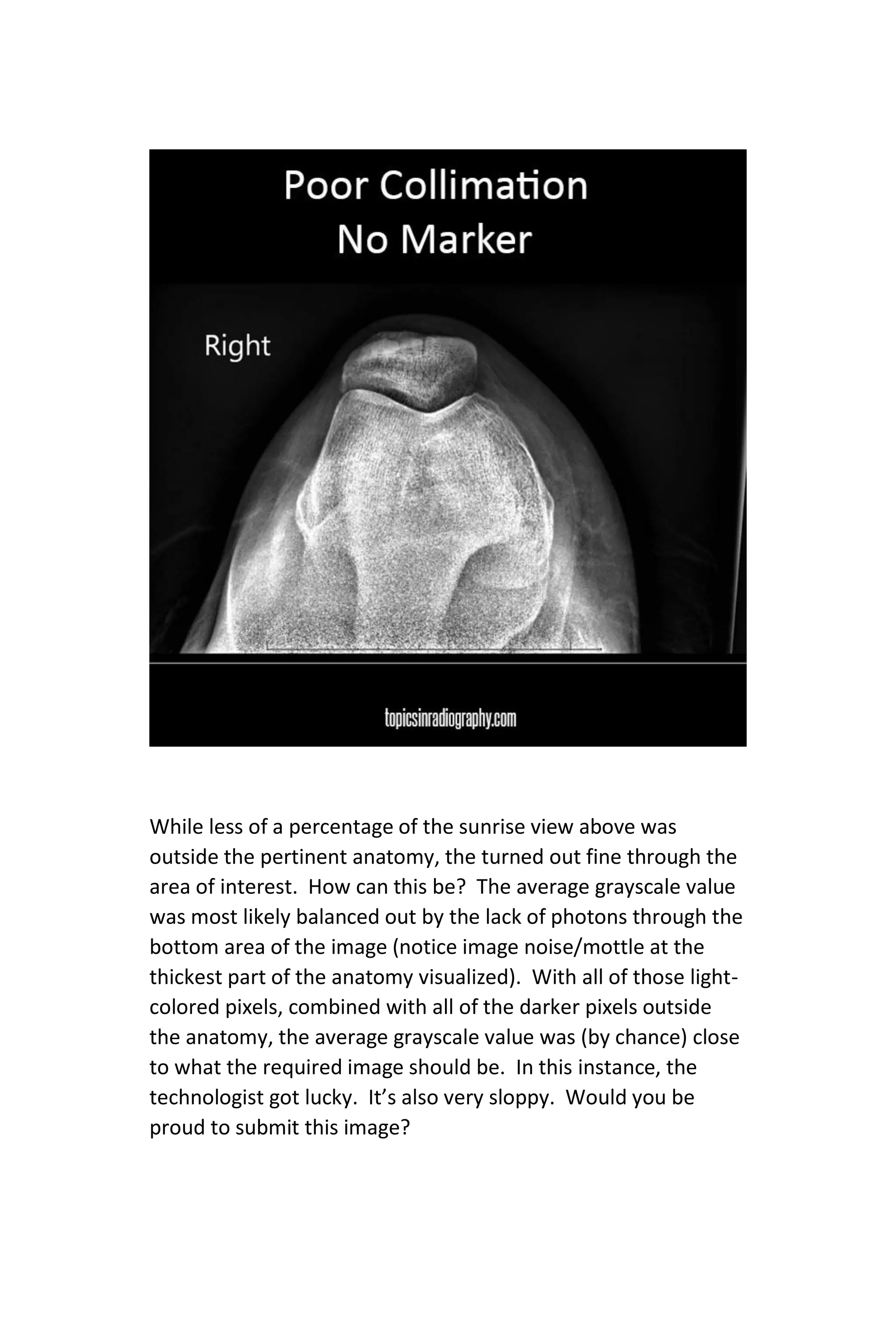 While less of a percentage of the sunrise view above was
outside the pertinent anatomy, the turned out fine through the
area of interest. How can this be? The average grayscale value
was most likely balanced out by the lack of photons through the
bottom area of the image (notice image noise/mottle at the
thickest part of the anatomy visualized). With all of those light-
colored pixels, combined with all of the darker pixels outside
the anatomy, the average grayscale value was (by chance) close
to what the required image should be. In this instance, the
technologist got lucky. It’s also very sloppy. Would you be
proud to submit this image?
 