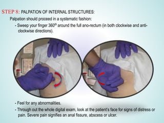 STEP 8: PALPATION OF INTERNAL STRUCTURES:
Palpation should proceed in a systematic fashion:
- Sweep your finger 360o around the full ano-rectum (in both clockwise and anti-
clockwise directions).
- Feel for any abnormalities.
- Through out the whole digital exam, look at the patient’s face for signs of distress or
pain. Severe pain signifies an anal fissure, abscess or ulcer.
 