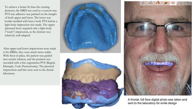 Digital Removable Complete Denture—an Overview.pptx | Dental Health ...