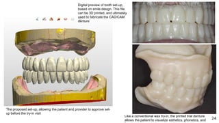 Digital Removable Complete Denture—an Overview.pptx