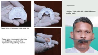Digital Removable Complete Denture—an Overview.pptx