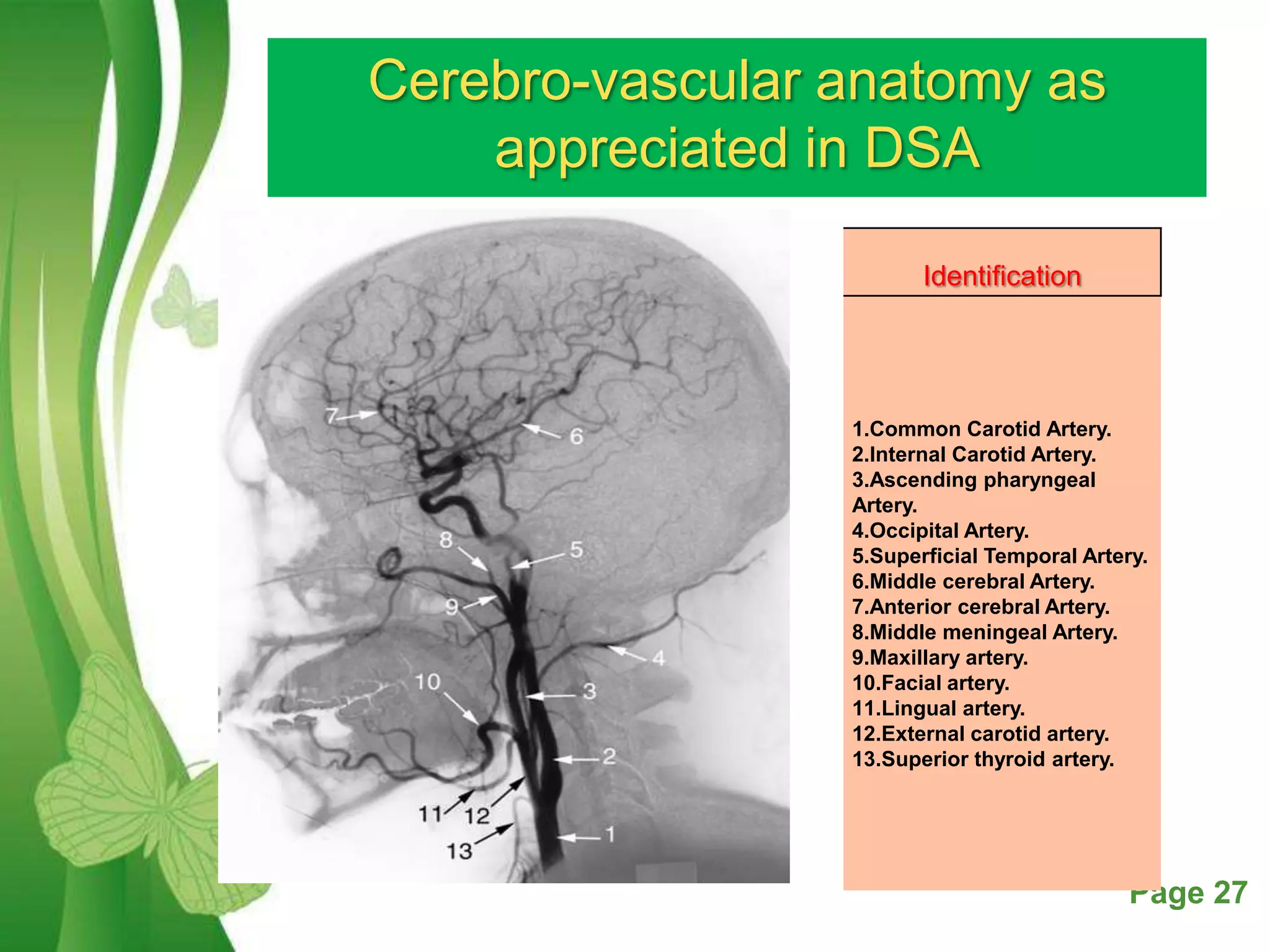 Dsa Radiology Digital subtraction angiography | PPTX