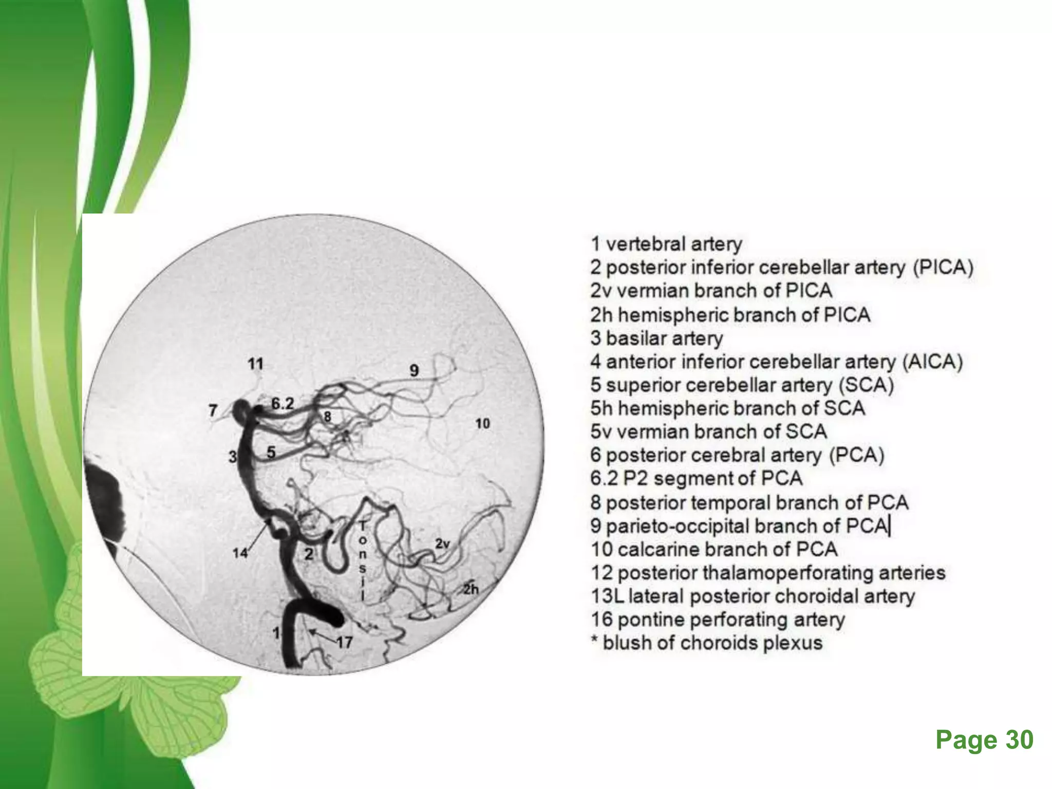 Dsa Radiology Digital subtraction angiography | PPTX