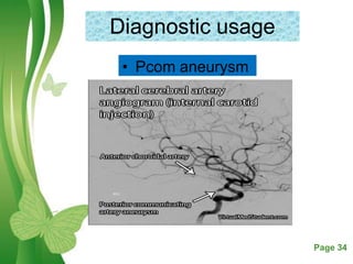 Free Powerpoint Templates Page 34
Diagnostic usage
• Pcom aneurysm
 