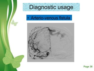 Free Powerpoint Templates Page 38
Diagnostic usage
• Arterio-venous fistula
 