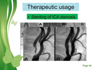 Free Powerpoint Templates Page 44
Therapeutic usage
• Stenting of ICA stenosis
 
