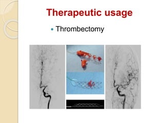Therapeutic usage
 Thrombectomy
 