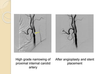 After angioplasty and stent
placement
High grade narrowing of
proximal internal carotid
artery
 