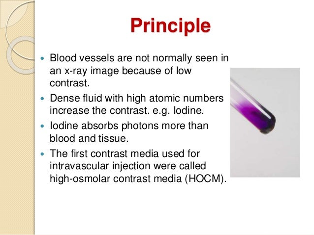 Digital subtraction angiography