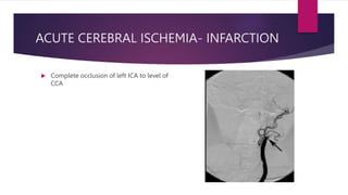 Ica Infarct DIGITAL SUBTRACTION ANGIOGRAPHY IN CEREBROVASCULAR DISEASE AND ...