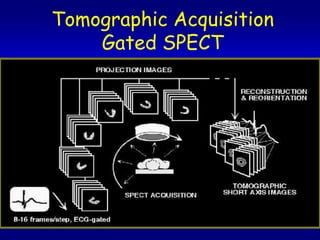 Tomographic Acquisition
    Gated SPECT
 