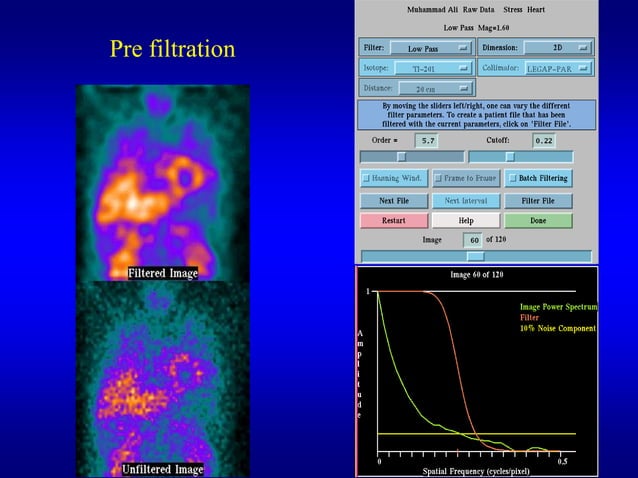 Digital Techniques For Myocardial Perfusion Spect | PPTX | Photo ...