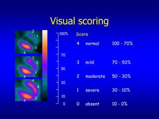 Visual scoring
    2
        1
                  100%   Score

                         4   normal     100 - 70%
        0
4
                  70
    3
        2                3   mild       70 - 50%
                  50
        1
4                        2   moderate   50 - 30%
    4
                  30
            4
                         1   severe     30 - 10%
        2         10
4
                   0     0   absent     10 - 0%
 