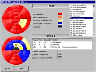 Digital Techniques For Myocardial Perfusion Spect