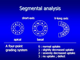 Segmental analysis
                short-axis                     V-long axis
                              16   9
        8   1                                        17
    7           2        15             10                18
    6           3        14             11                19
        5   4                 13   12                20


     apical                   basal

A four-point                   0   :   normal uptake
grading system                 1   :   slightly decreased uptake
                               2   :   severely decreased uptake
                               3   :   no uptake ; defect
 