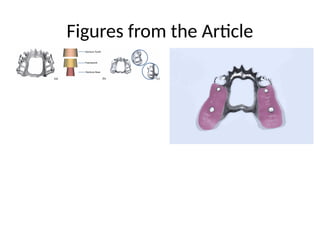Digital_Workflow_RPD_with_Biomechanics_and_Force_Diagram.pptx