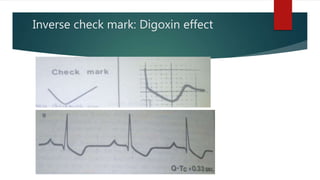 Inverse check mark: Digoxin effect
 