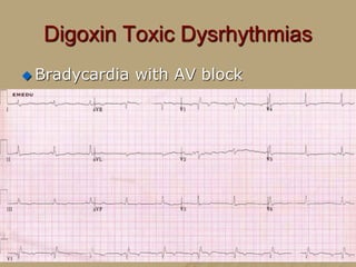 Digoxin- GLYCOSIDE | PPTX