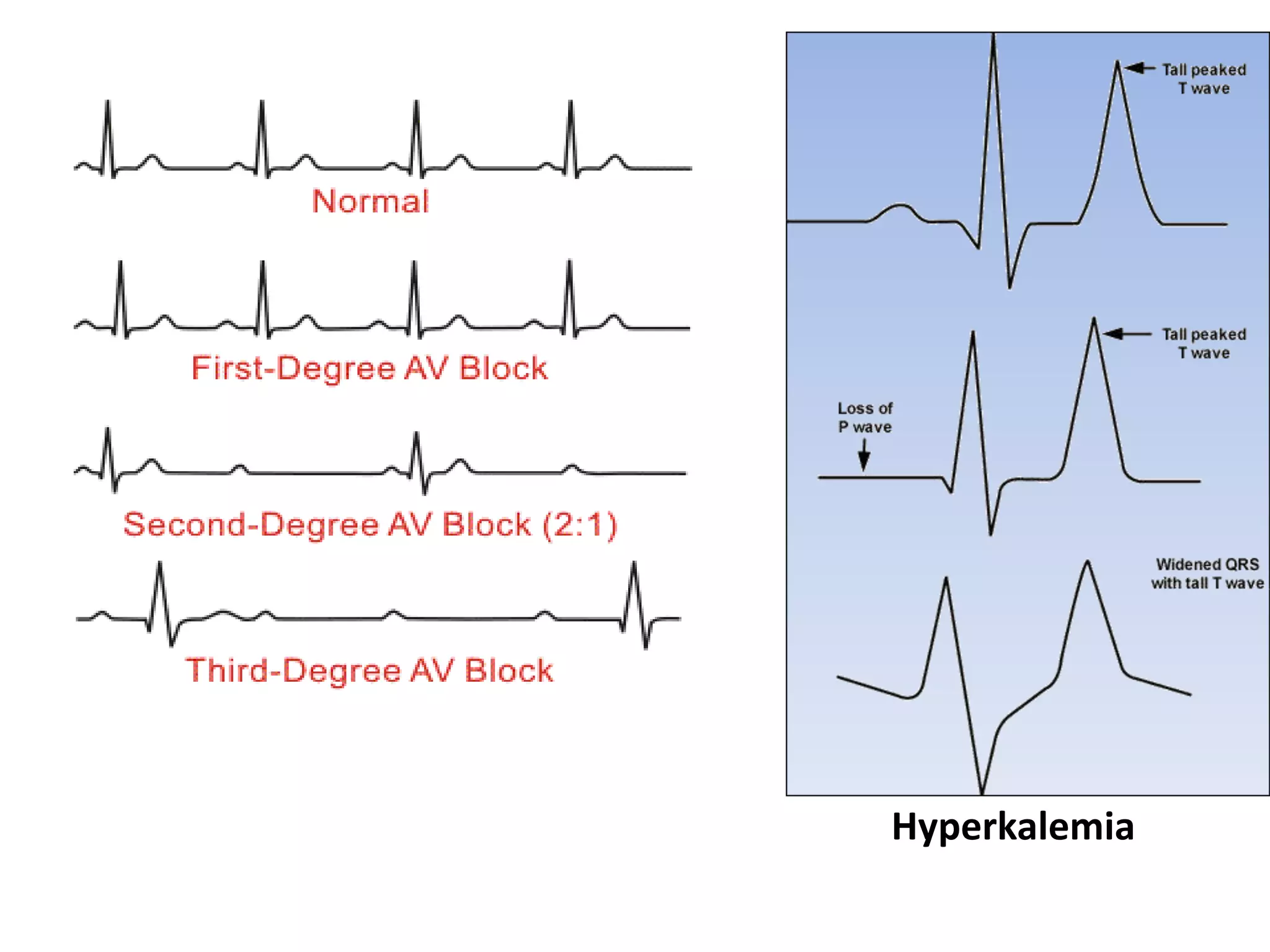Digoxin toxicity | PPTX