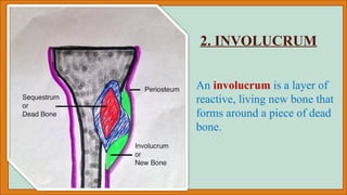 Comprehensive Overview of Osteomyelitis and Asthimajjagata Vidradhi ...