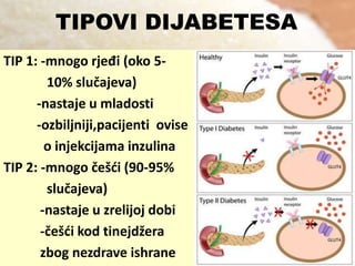TIPOVI DIJABETESA
TIP 1: -mnogo rjeđi (oko 510% slučajeva)
-nastaje u mladosti
-ozbiljniji,pacijenti ovise
o injekcijama inzulina
TIP 2: -mnogo češdi (90-95%
slučajeva)
-nastaje u zrelijoj dobi
-češdi kod tinejdžera
zbog nezdrave ishrane

 