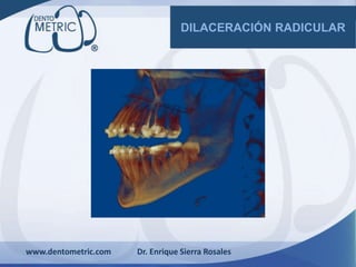 www.dentometric.com Dr. Enrique Sierra Rosales
DILACERACIÓN RADICULAR
 