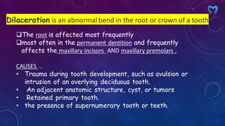 Dilaceration is an abnormal bend in the root or crown of a tooth
❑The root is affected most frequently
❑most often in the permanent dentition and frequently
affects the maxillary incisors AND maxillary premolars .
CAUSES - ,.
• Trauma during tooth development, such as avulsion or
intrusion of an overlying deciduous tooth.
• An adjacent anatomic structure, cyst, or tumors
• Retained primary tooth.
• the presence of supernumerary tooth or teeth.
 