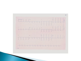 Dilatação das câmaras cardíacas