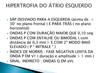    SÂP DESVIADO PARA A ESQUERDA (acima de +
    30° no plano frontal ) E PARA TRÁS ( no plano
    horizontal)
   ONDAS P COM DURAÇÃO MAIOR QUE 0,10 seg
   ONDAS P COM ENTALHE OU BIMODAL ( com
    distância de 0,3 mm ) E COM 2º MODO MAIS
    ELEVADO ( P “ MITRALE “ )
   ÍNDICE DE MORRIS : FASE NEGATIVA LENTA DA
    ONDA P EM V1 ( duração e amplitude > 1 mm )
   SINAL INDIRETO : ONDAS Q EM aVL
 