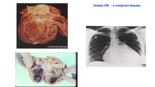 Dilated cardiomyopathy | PDF