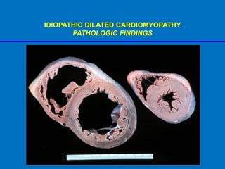 IDIOPATHIC DILATED CARDIOMYOPATHY
PATHOLOGIC FINDINGS
 