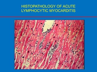 HISTOPATHOLOGY OF ACUTE
LYMPHOCYTIC MYOCARDITIS
 