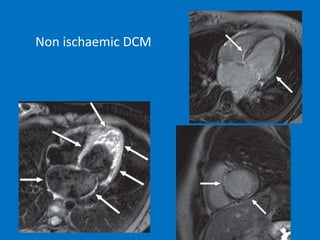 Non ischaemic DCM
 